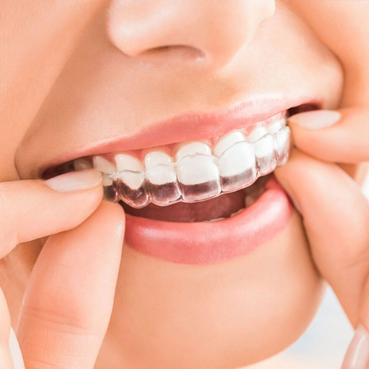 Invisalign-per-sito